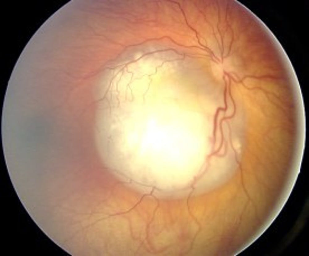 Aspecto de un retinoblastoma.