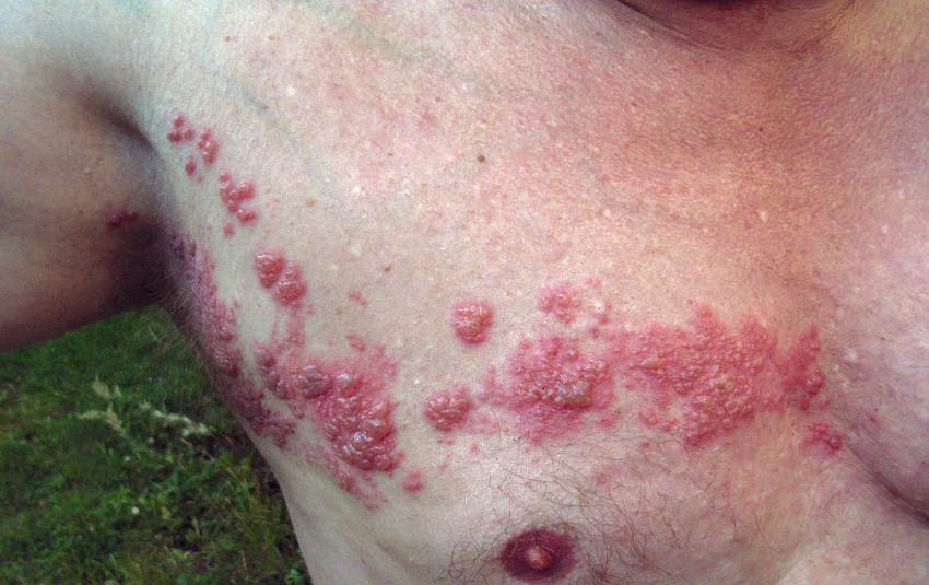 Herpes Zóster (Culebrilla): cómo tratar esta dolorosa enfermedad.