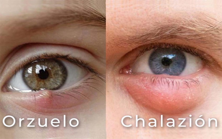 ¿Qué es un orzuelo y un chalazión Causas, síntomas y tratamientos.