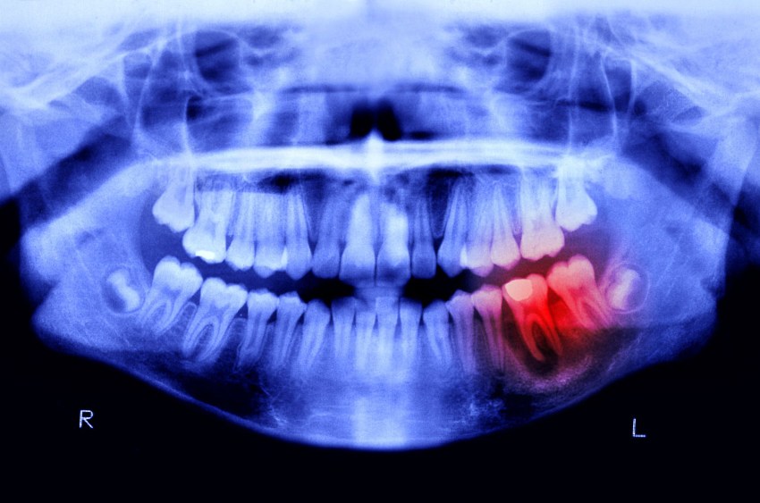 Científicos japoneses desarrollan el primer fármaco para regenerar dientes perdidos.