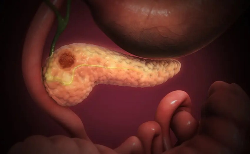 Los síntomas silenciosos del cáncer de páncreas que debes conocer.