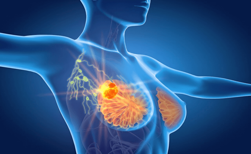Señales tempranas de cáncer de mama que a menudo se ignoran.