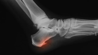 Espolón calcáneo: cuando el verdadero dolor no está en el zapato… sino en un hueso que punza desde dentro. Espolón calcáneo: cuando el verdadero dolor no está en el zapato
