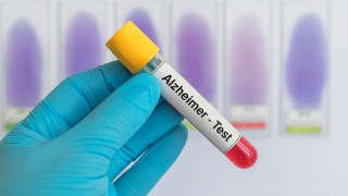 Este análisis de sangre puede detectar el Alzheimer antes de que aparezcan los primeros síntomas. Este análisis de sangre puede detectar el Alzheimer antes de que aparezcan los primeros síntomas.