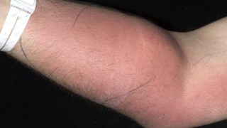Un hombre se inyectó su propio semen en el brazo para curar su dolor de espalda crónico. Un hombre se inyectó su propio semen en el brazo para curar su dolor de espalda crónico.