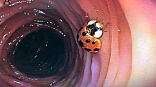 Un paciente fue a hacerse una colonoscopia… y le encuentran una mariquita viva en su colon. Un paciente fue a una colonoscopia... y encontraron una mariquita viva en su colon.