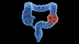 ¿Y si el ejercicio fuera parte del tratamiento? Caminar podría reducir el riesgo de muerte por cáncer de colon. ¿Y si el ejercicio fuera parte del tratamiento? Caminar podría reducir el riesgo de muerte por cáncer de colon.