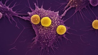 Crean una vacuna "universal" contra el cáncer que entrena al sistema inmunológico para eliminar cualquier tumor. Crean una vacuna universal contra el cáncer que entrena al sistema inmunológico para eliminar cualquier tumor.