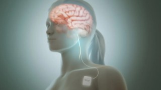 La estimulación del nervio vago puede reducir la inflamación que causa enfermedades crónicas. La estimulación del nervio vago puede reducir la inflamación que causa enfermedades crónicas.