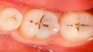 No solo el azúcar: ahora identifican otro alimento común que también puede causar caries dental. No solo el azúcar ahora identifican otro alimento común que también puede causar caries dental.