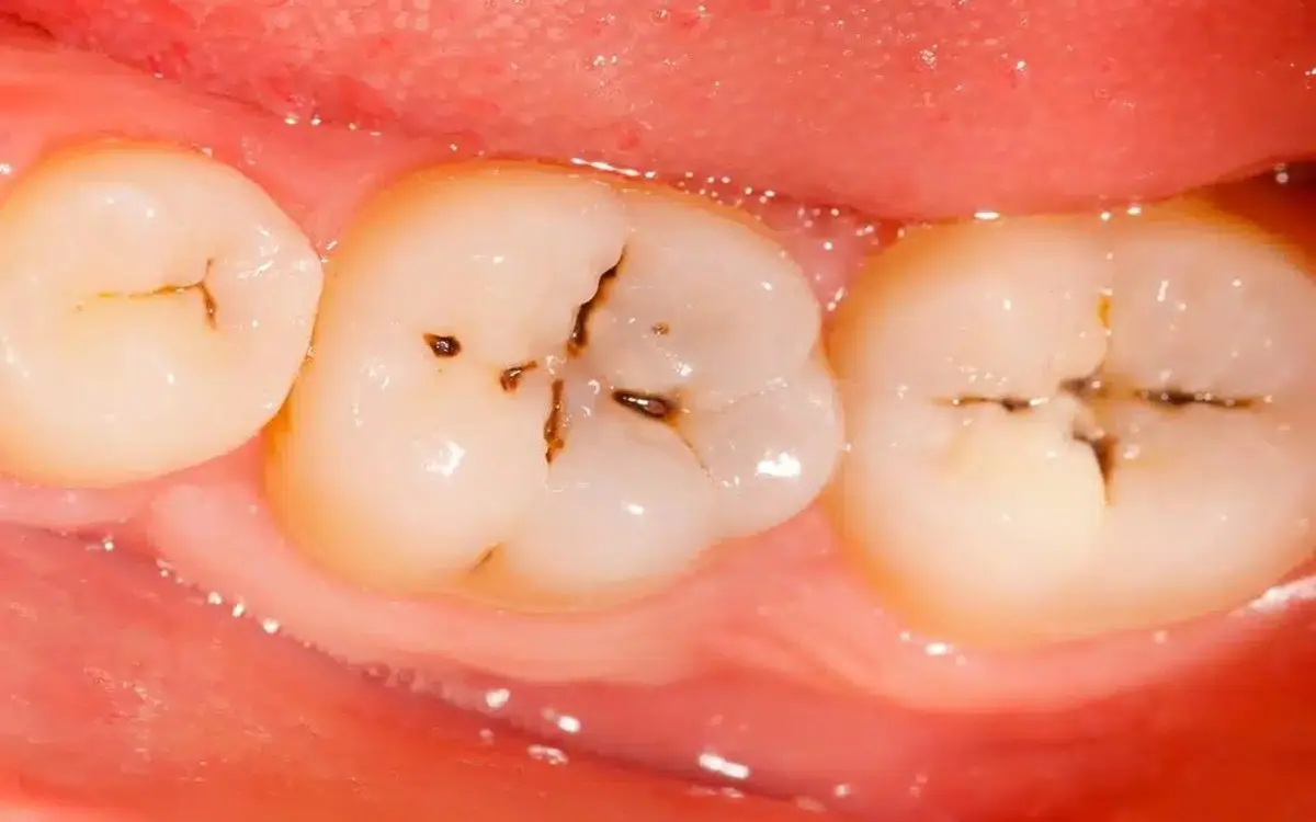 No solo el azúcar: ahora identifican otro alimento común que también puede causar caries dental. No solo el azúcar ahora identifican otro alimento común que también puede causar caries dental.