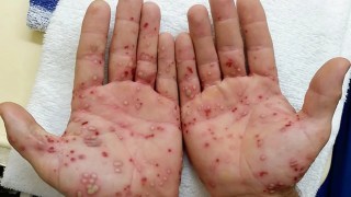 Un hombre tuvo una infección de garganta y terminó con las manos y los pies llenos de ampollas. Un hombre tuvo una infección de garganta y terminó con las manos y los pies llenos de ampollas.