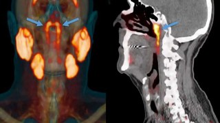 Científicos descubren un nuevo órgano oculto en la garganta humana. Científicos descubren un nuevo órgano oculto en la garganta humana.