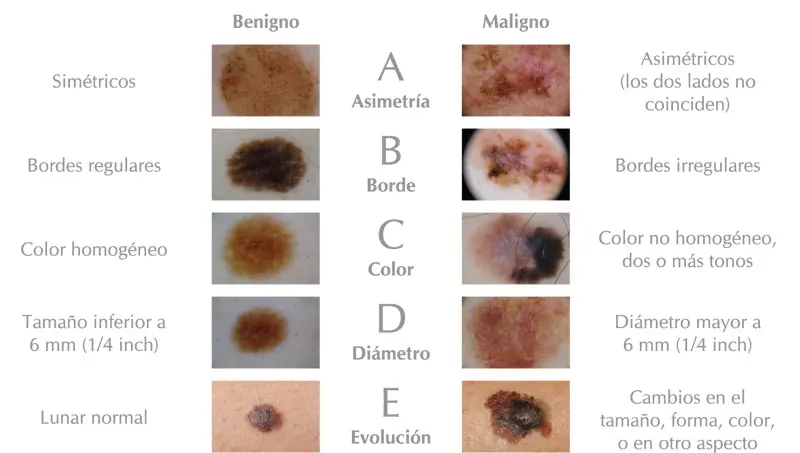 Aprende a diferenciar un lunar benigno de uno maligno con la regla ABCDE