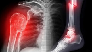 Científicos crean un hidrogel inyectable que regenera huesos dañados solo en 28 días usando luz visible. crean un hidrogel inyectable que regenera huesos dañados solo en 28 días