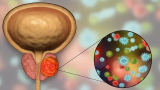 Descubren una enzima clave para frenar el cáncer de próstata resistente a los tratamientos convencionales. Descubren una enzima clave para frenar el cáncer de próstata resistente a los tratamientos convencionales.
