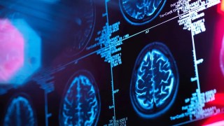 El Alzheimer podría comenzar en tu boca: descubren bacterias bucales vinculadas a la enfermedad. El Alzheimer podría comenzar en tu boca