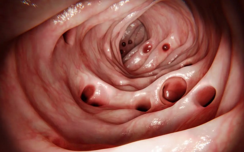 La mayoría de las personas desarrolla diverticulosis en la edad adulta