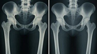 Los científicos descubren la clave para fortalecer los huesos y revertir la osteoporosis. Los científicos descubren la clave para fortalecer los huesos y revertir la osteoporosis.