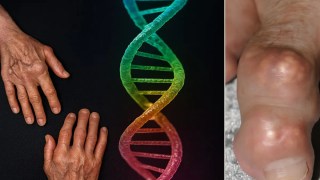 Científicos reviven un gen perdido de hace 20 millones de años para combatir la gota. Científicos reviven un gen perdido de hace 20 millones de años para combatir la gota en células humanas.