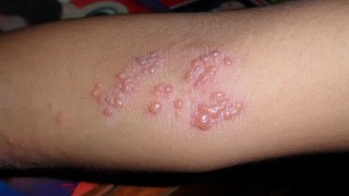 5 mitos sobre el herpes zóster que tu médico quiere que dejes de creer.