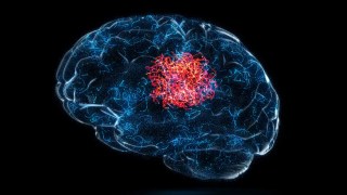 Científicos descubren que un antidepresivo común es capaz de frenar el cáncer cerebral más agresivo. Científicos descubren que un antidepresivo común es capaz de frenar el cáncer cerebral más agresivo.