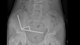 Un adolescente de 13 aƱos pierde parte de su intestino tras tragarse casi 200 imanes comprados en Temu. Un adolescente de 13 aƱos pierde parte de su intestino tras tragarse casi 200 imanes comprados en Temu.
