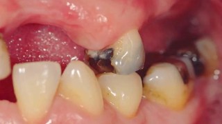 Un estudio revela que perder los dientes podrĂa ser una señal de muerte prematura. Un estudio revela que perder los dientes podrĂa ser una señal de muerte prematura.