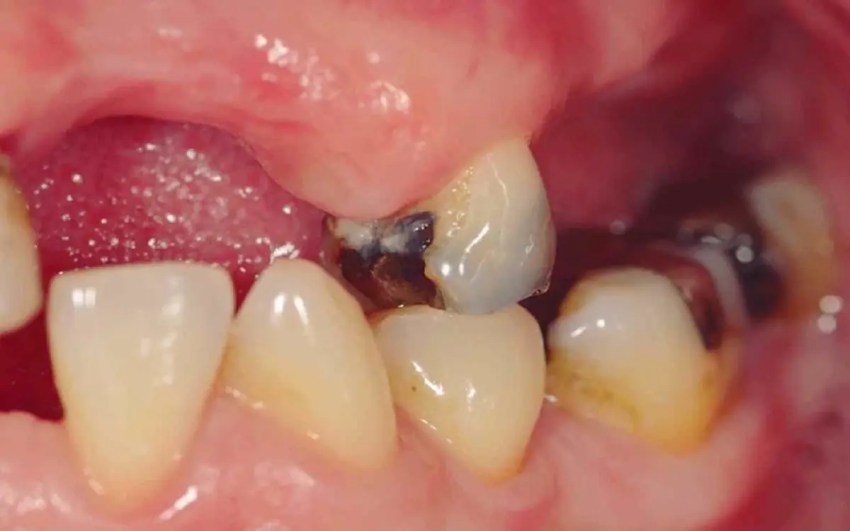 Un estudio revela que perder los dientes podría ser una señal de muerte prematura.