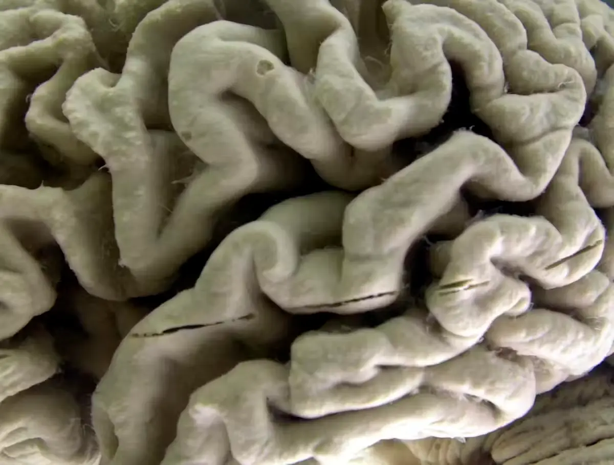 Una sección de un cerebro humano con la enfermedad de Alzheimer expuesta en el Museo de Neuroanatomía de la Universidad de Búfalo, en Búfalo, N.Y. (AP Photo/David Duprey)