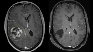Científicos desarrollan unas gotas nasales que podrían combatir el cáncer cerebral más agresivo. Científicos desarrollan unas gotas nasales que podrían combatir el cáncer cerebral más agresivo.