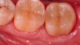 ¿AdiĂ³s a la caries? CientĂficos descubren una forma de regenerar el esmalte dental. CientĂficos descubren una forma de regenerar el esmalte dental.