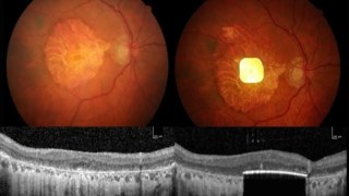 Por primera vez, un microchip implantado en el ojo logra restaurar la visión en pacientes con ceguera avanzada. Por primera vez, un microchip implantado en el ojo logra restaurar la visión en pacientes con ceguera avanzada.