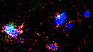 Un nuevo fármaco logra frenar el avance del Alzheimer en estudios preclínicos. Un nuevo fármaco logra frenar el avance del Alzheimer en estudios preclínicos.