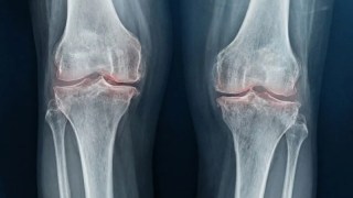 Un fármaco experimental logra regenerar articulaciones dañadas y aliviar el dolor de la osteoartritis. Un fármaco experimental logra regenerar articulaciones dañadas y aliviar el dolor de la osteoartritis.