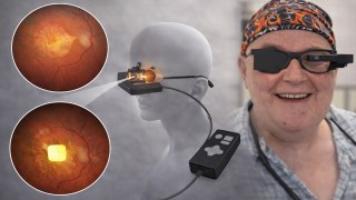 Un implante en la retina devuelve visión central a 38 personas con ceguera avanzada. Un implante en la retina devuelve visión central a 38 personas con ceguera avanzada.