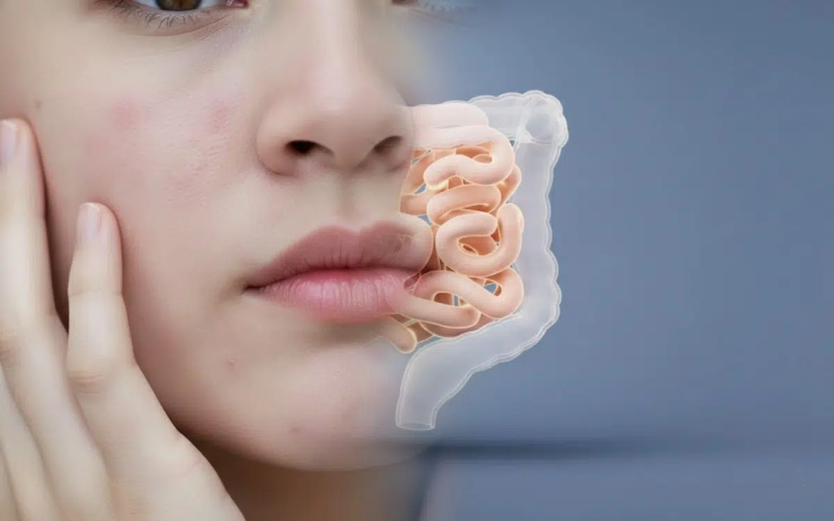 Tu piel puede estar reflejando tu intestino: la razón oculta del acné y la dermatitis. Tu piel puede estar reflejando tu intestino: la razón oculta del acné y la dermatitis.