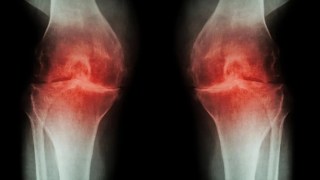 ¿Realmente funciona el ejercicio para la artrosis? La ciencia revisa la evidencia… y los resultados sorprenden. Realmente funciona el ejercicio para la artrosis