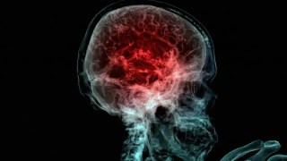 Detectan microplásticos en el cerebro humano… y las concentraciones siguen aumentando con el tiempo. Detectan microplásticos en el cerebro humano