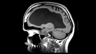 Este hombre llevaba una vida normal… a pesar de haber perdido el 90% de su cerebro. Este hombre llevaba una vida normal… a pesar de haber perdido el 90% de su cerebro.