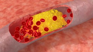 Los cardiólogos acaban de publicar nuevas reglas para controlar el colesterol malo con mayor eficacia. Los cardiólogos acaban de publicar nuevas reglas para controlar el colesterol malo con mayor eficacia.