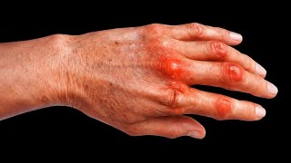 Desarrollan un fármaco que podría frenar la aparición de la artritis reumatoide en personas de alto riesgo. Desarrollan un fármaco que podría frenar la aparición de la artritis reumatoide en personas de alto riesgo.