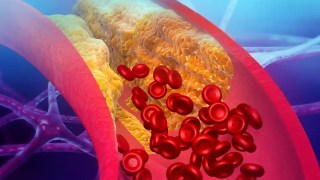 Los médicos lograron revertir la obstrucción de arterias del corazón en dos pacientes con un sencillo suplemento. Los médicos lograron revertir la obstrucción de arterias del corazón en dos pacientes con un sencillo suplemento.