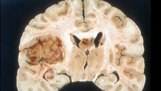 Crean nanopartículas que atraviesan la barrera cerebral para atacar el glioblastoma, el cáncer cerebral más mortal. Crean nanopartículas que atraviesan la barrera cerebral para atacar el glioblastoma