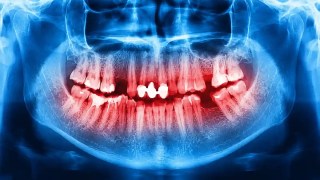 Revelan una dieta capaz de reducir la inflamación asociada a la enfermedad periodontal. Revelan una dieta capaz de reducir la inflamación asociada a la enfermedad periodontal.