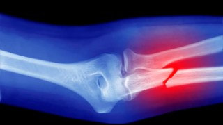 Los suplementos que muchos toman para fortalecer los huesos ofrecen poco o ningún beneficio para prevenir fracturas. Los suplementos que muchos toman para fortalecer los huesos ofrecen poco o ningún beneficio para prevenir fracturas.
