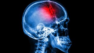 Un estudio revela un aumento alarmante de accidentes cerebrovasculares entre adultos jóvenes. Un estudio revela un aumento alarmante de accidentes cerebrovasculares entre adultos jóvenes.